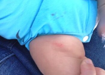 Bebê de 50 dias sofre lesões corporais