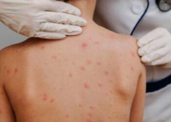 Cidades Catarinenses confirmam casos de sarna humana em escolas e creches