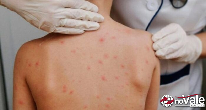 Cidades Catarinenses confirmam casos de sarna humana em escolas e creches