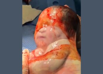 Bebê nasce empelicada em um parto raro na região