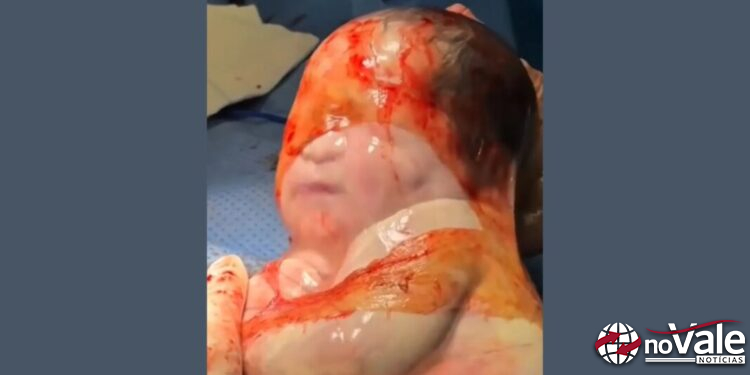 Bebê nasce empelicada em um parto raro na região