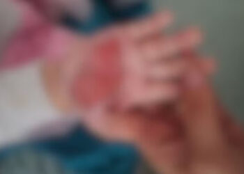 Mulher queima mão de enteada de 2 anos com colher quente para castigá-la em SC