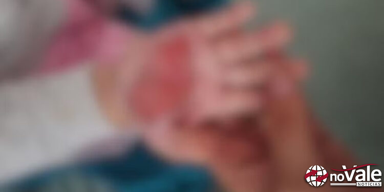 Mulher queima mão de enteada de 2 anos com colher quente para castigá-la em SC