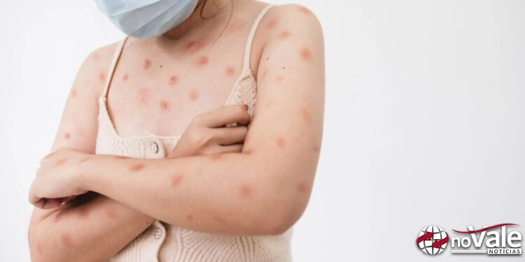 Sete casos suspeitos de Mpox são registrados em SC