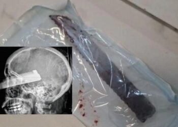 “Ficou cega” marido cheira cocaína e crava faca no rosto da esposa em Santa Catarina