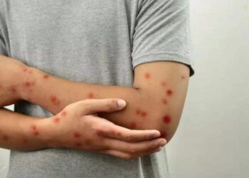 Casos de Mpox no Brasil chegam a 140 em 2026; SC registra confirmações