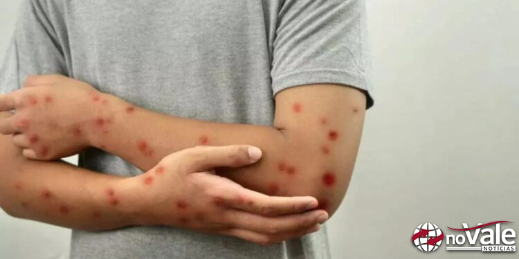 Casos de Mpox no Brasil chegam a 140 em 2026; SC registra confirmações