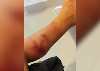 Criança de 3 anos é atacada por cachorro próximo a creche em Ponte Serrada