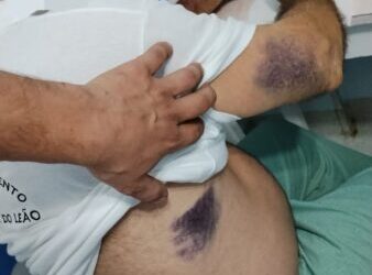 Idoso é picado por jararaca na Barra do Leão, perde forças e se arrasta até pedir socorro