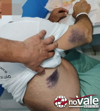 Idoso é picado por jararaca na Barra do Leão, perde forças e se arrasta até pedir socorro