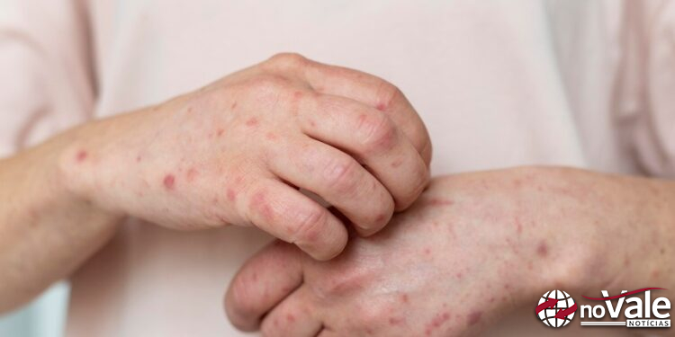 Após homem sofrer choque anafilático em instituição financeira de Capinzal, médica orienta sobre os riscos e cuidados